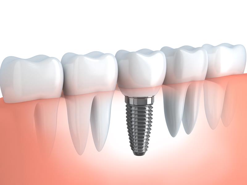 Dental Implants Roanoke, VA