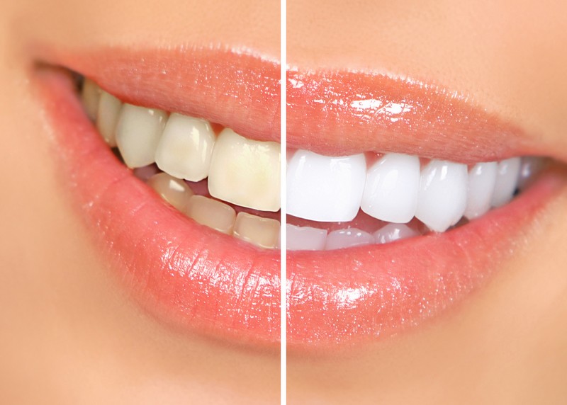 Teeth Whitening  Roanoke, VA 