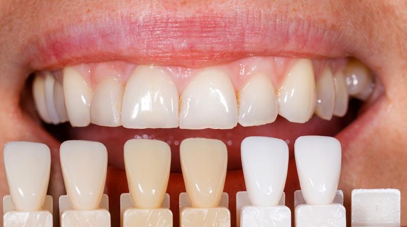 Veneers  Roanoke, VA 